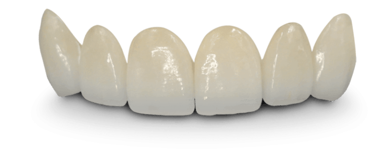 Dental bridge front teeth