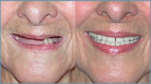 Janice Before and After Dental Implants
