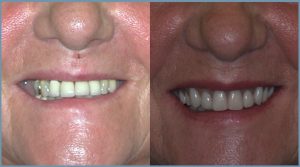 Linda Before and After Dental Implants