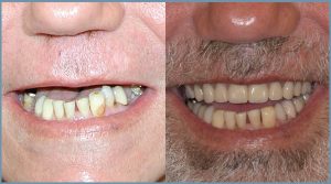 Robert Before and After Dental Implants